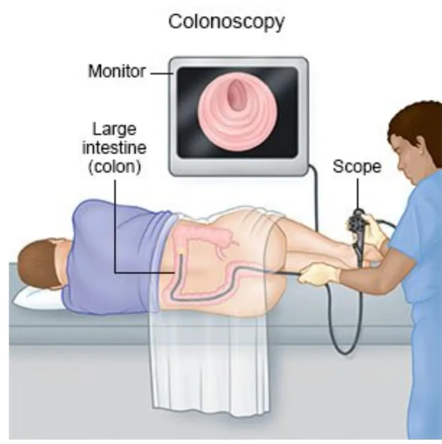 colonoscopia